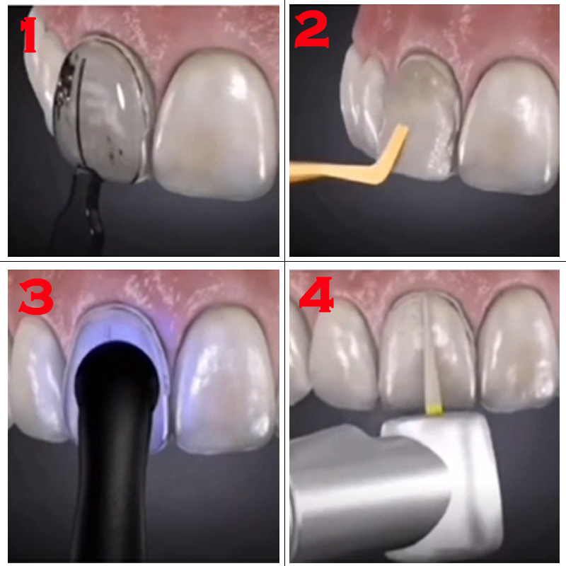 Kit de laboratorio dental de 3 - Teeth Whitening Moulds reseña y precio