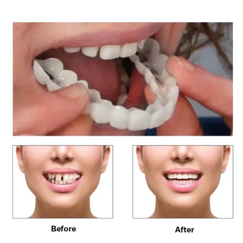 Kit de carillas dentales ajust - Teeth Whitening Kit reseña y precio